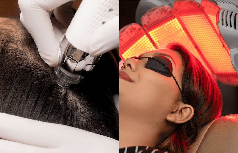 DNA Salmon for Alopecia Therapy